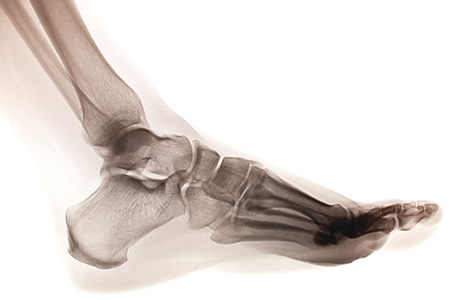 Ankle Sprains Physical Therapy NYC