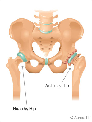 Hip Arthritis Treatment