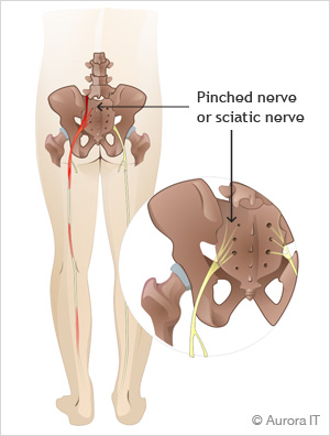 Pinched Nerve: Pinched Nerve On Back