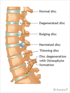 Degenerative Joint / Disc Disease treatment manhattan