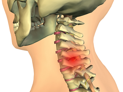 Cervical Disc Herniations