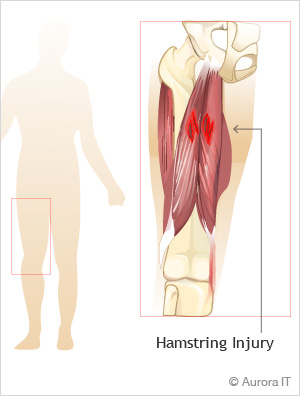 Hamstring Injuries Treatment Manhattan