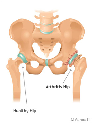 Hip Arthritis Pain Relief NYC Hip Arthritis Treatment
