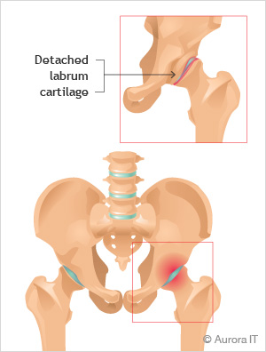 Labral Tears Treatment