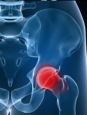 Hip impingement diagnosis and treatment NYC