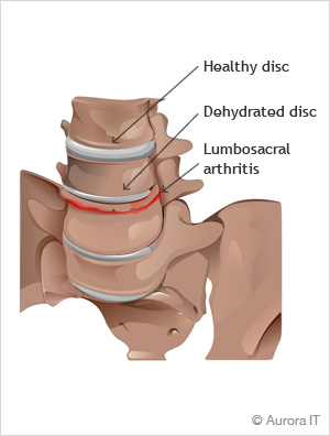 Lower back pain and arthritis, NYC