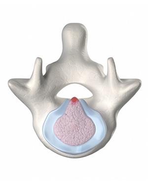 Lumbar Stenosis/Spinal Stenosis