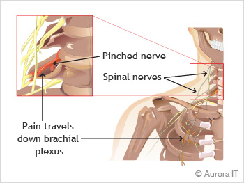 Trapped nerve online in back