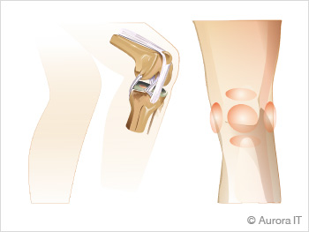 Post Surgery Knee Pain Treatment Manhattan