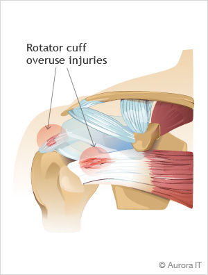 Rotator Cuff Treatment