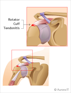 Rotator Cuff Tendonitis