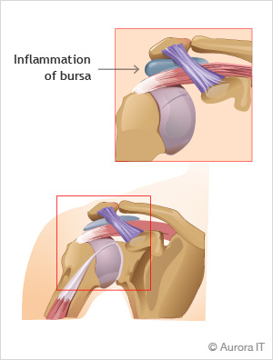 Shoulder Bursitis Treatment